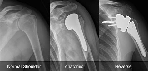 Combined-shoulder-TSA-RSA - Shoulder & Elbow