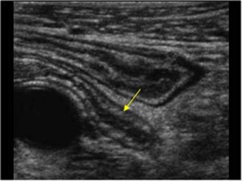 Abdomen and retroperitoneum | 1.5 Appendix : Case 1.5.1 Normal appendix | Ultrasound Cases