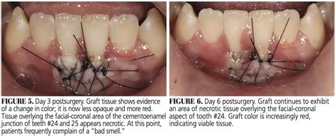 Healing Progression of the Free Gingival Graft - Decisions in Dentistry