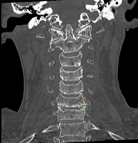 Subaxial Cervical Spine CT - Clinical Tree