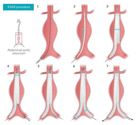 Aortic aneurysm surgery in Iran - Diagnosis and treatment 2023 - irantreatments - Plastic ...