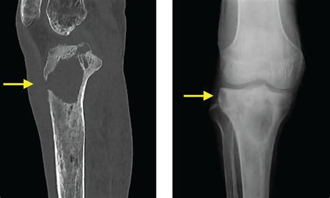 Brodie abscess in an 87-year-old man | Cleveland Clinic Journal of Medicine