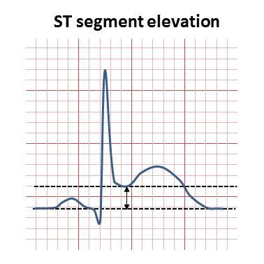 ST elevation - Wikiwand