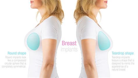 Breast Implant Types - Northern Virginia- Washington DC - The Naderi Center