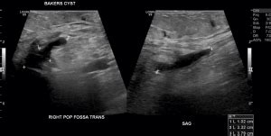 Baker's Cyst - Symptoms, Diagnois and Treatment Options