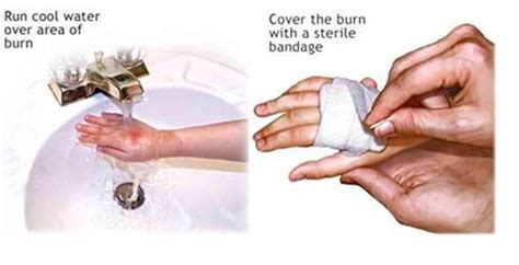 First Aid For Burns – What Is It? – Health Brisbane