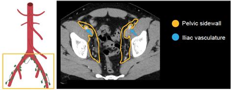 Abdominal CT: lymph nodes • LITFL • Radiology Library