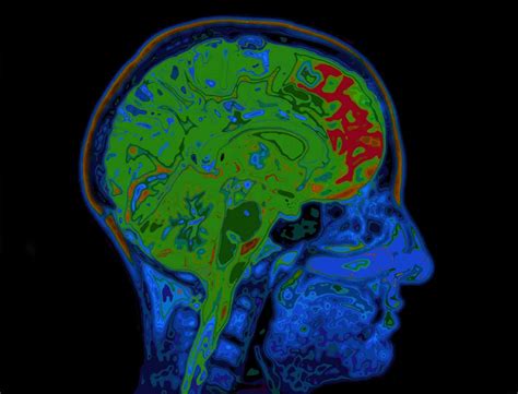 Understanding Parietal Lobe Injuries | Willens & Baez