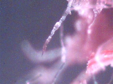 Morgellons Disease symptoms - Morgellons Disease