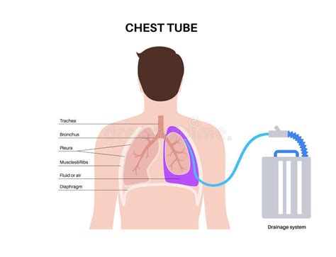 Chest tube catheter stock vector. Illustration of abscess - 277154094