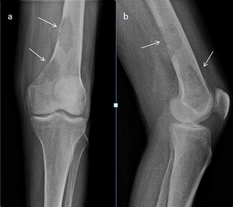 Osteosarcoma X Ray