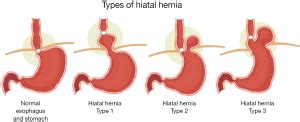 Which hiatal hernia’s need to be fixed? Large, small or none? - Dunn ...