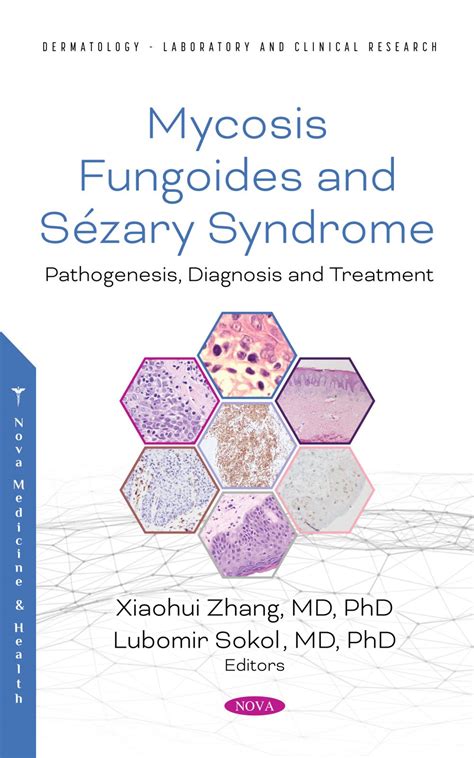 Mycosis Fungoides and Sézary Syndrome: Pathogenesis, Diagnosis and Treatment – Nova Science ...