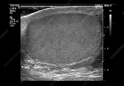 Normal testicle, ultrasound scan - Stock Image - C027/6000 - Science Photo Library