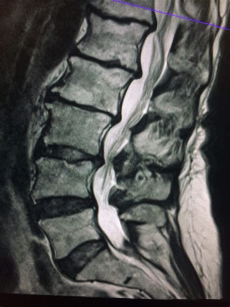 Lumbar Disc Disease Mri