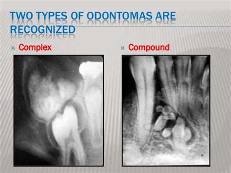 Odontoma