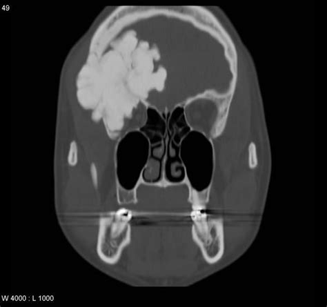 Osteoma of orbital roof | Radiology Case | Radiopaedia.org | Radiology ...