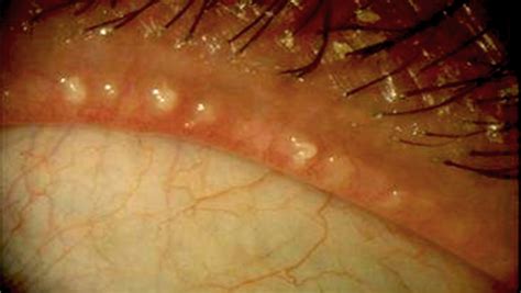 Meibomian Glad Dysfunction (MGD) and what to look out for! – Eye Lounge