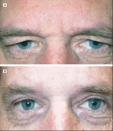 A, Preoperative photograph showing marked brow ptosis, dermatochalasis,... | Download Scientific ...