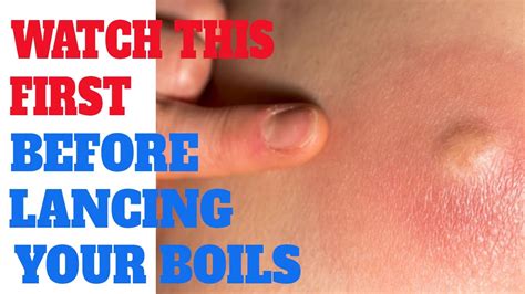 Lancing a boil | What You should do before lancing a boil | How to Lance | Pop - Boil Cyst - YouTube