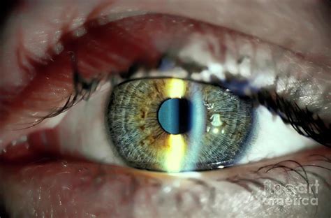 Slit Lamp Eye Examination Photograph by Patrick Landmann/science Photo Library