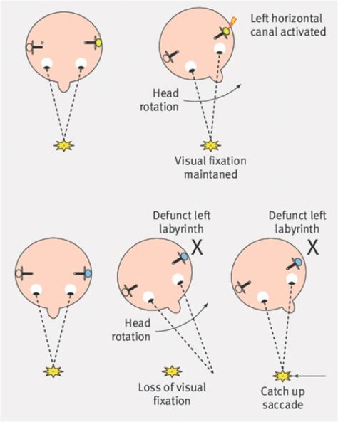 What Is the Head Impulse Test?