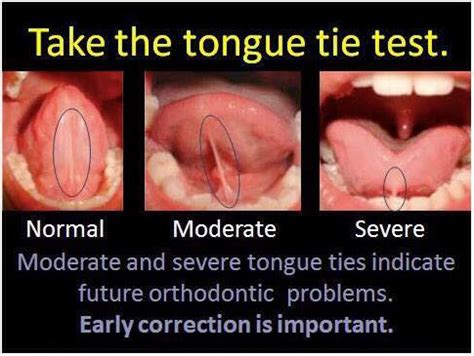 Tongue Tie – Innovative Myofunctional Therapy