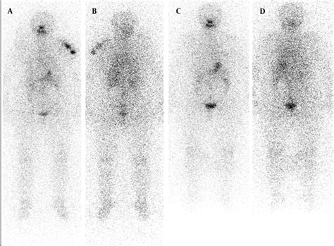 Radioactive Iodine Scan