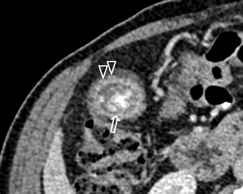 Gallbladder adenomyomatosis | Radiology Case - RadioGyan