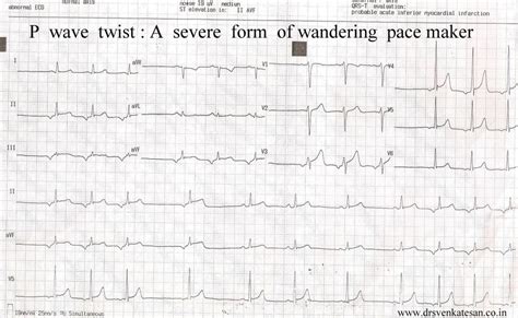 Wandering Atriyal Pacemaker (WAP) | Resüsitasyon