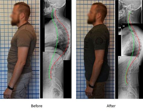 Cervical Kyphosis Exercises