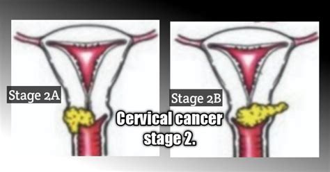 Understanding cervical cancer stages 2