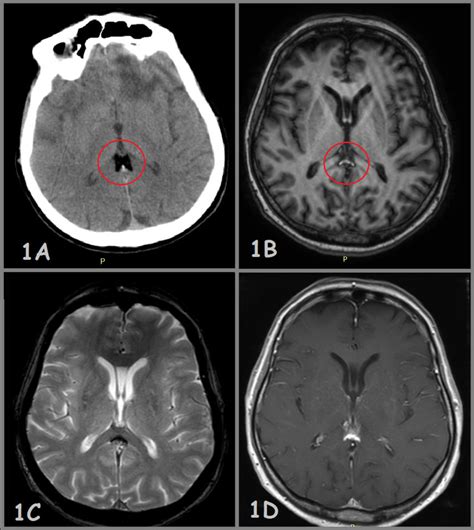 Lipoma of falx cerebri over the corpus callosum, which is presented... | Download Scientific Diagram