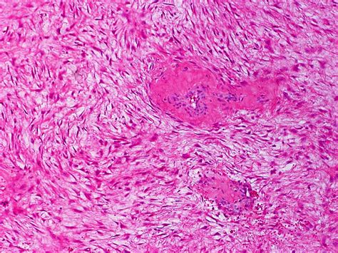 Fibromatosis, Aggressive; Desmoid