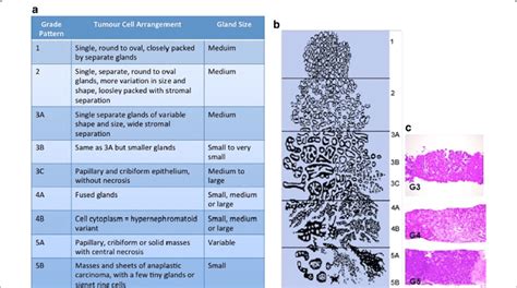 The Gleason Scoring System. Pathologists evaluate prostate biopsy... | Download Scientific Diagram