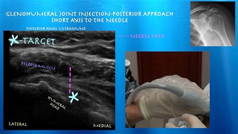 Glenohumeral Joint Injection Ultrasound