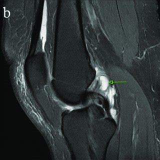 mucoid degeneration of acl treatment - speranzalindy