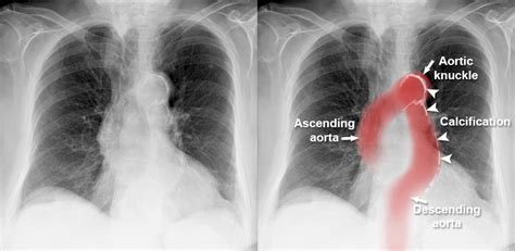 Unfolding Of Aorta On Chest X Ray