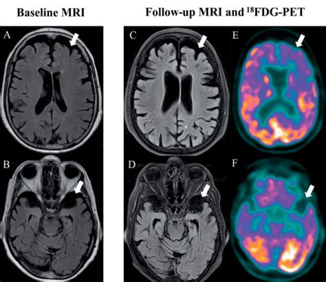 Frontotemporal Dementia - Knowledge and References | Taylor & Francis