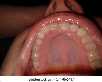 Hard And Soft Palate - cloudshareinfo