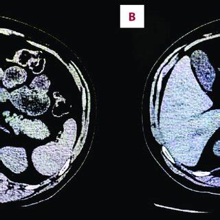 Endoscopic ultrasound showed a hypoechoic nodule in the tail of the ...