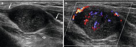 Fig. 18.3, [Longitudinal ultrasound of distal forearm...]. - Musculoskeletal Diseases 2021-2024 ...