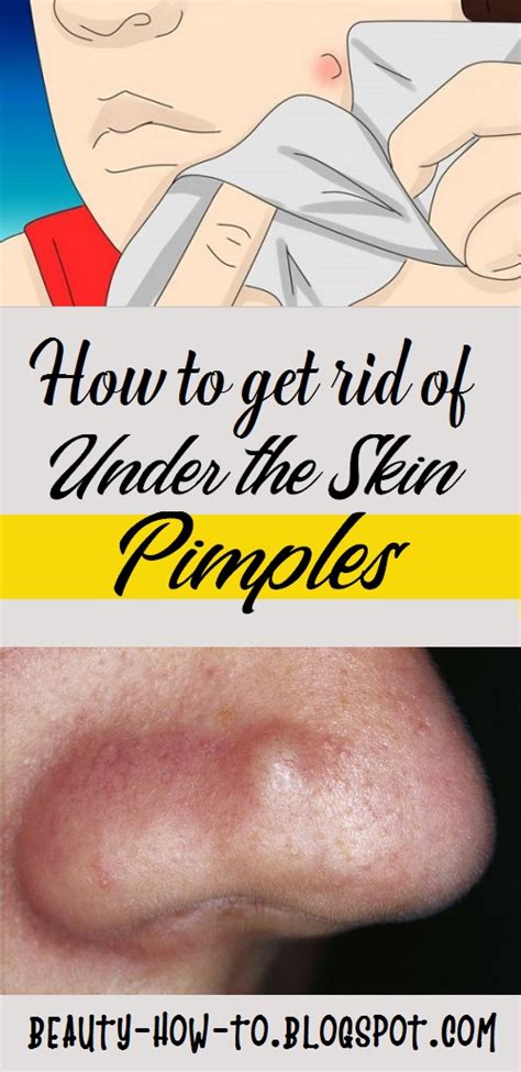 How to Get Rid of Under The Skin Pimples - How To Beauty