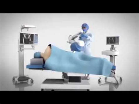 Stryker Mako robotic arm assisted total hip replacement - YouTube