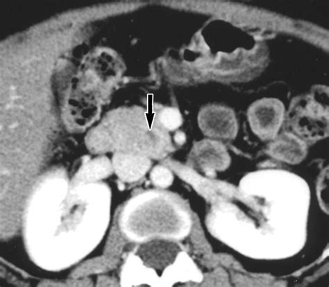 Helical CT of Islet Cell Tumors of the Pancreas: Typical and Atypical ...