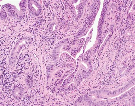 Histologic Variants of Urothelial Carcinoma: Morphology, Molecular Features and Clinical ...