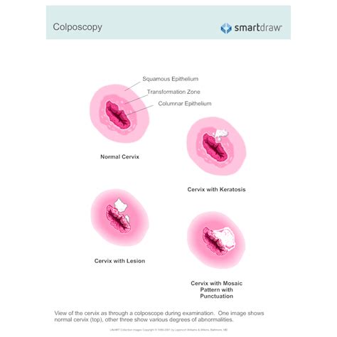 Colposcopy