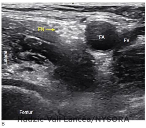 Ultrasound-Guided Femoral Nerve Block - NYSORA The New York School of Regional Anesthesia