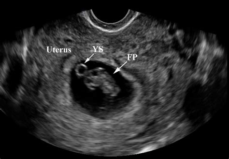 OB/Gyn Images | Emergency Ultrasonography