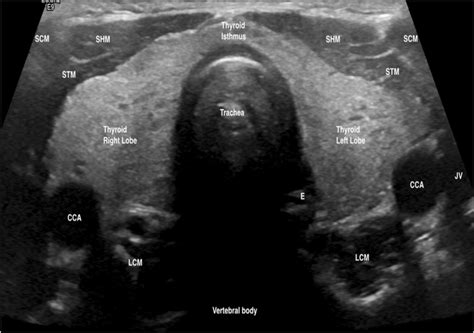 Normal Thyroid Ultrasound